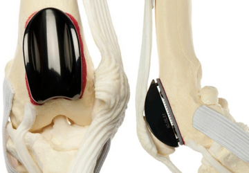 Patellar Groove Replacement